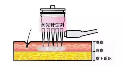 面部黑毛毛孔粗大,毛孔粗大面部暗沉