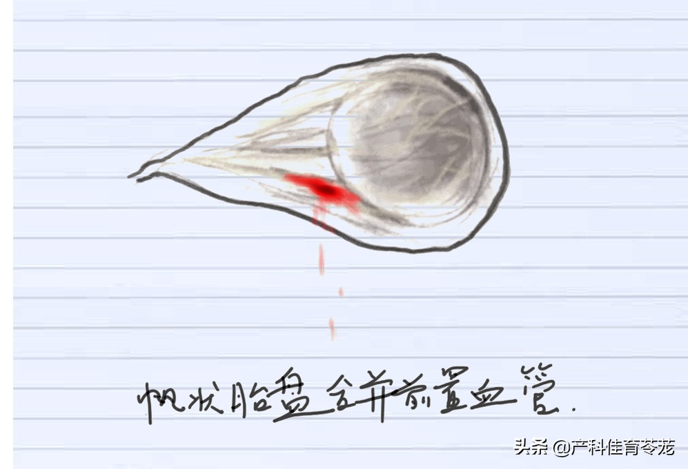 前置血管容易断裂吗,前置血管破裂对母体有什么伤害