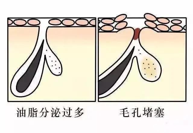 医美刷酸后爆痘期要多久,痘痘肌医美刷酸能好吗