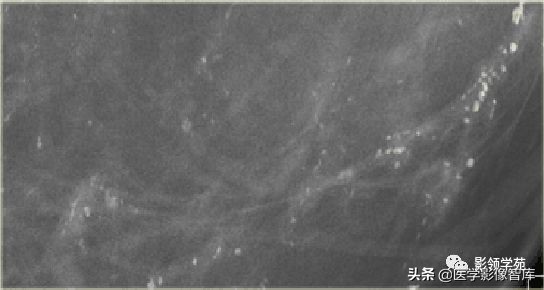 乳腺钙化怎么区分良性和恶性,乳腺钙化的诊断与分级