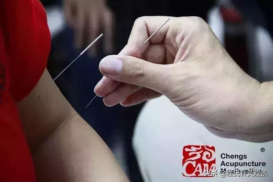 程莘农三才针法,程莘农程氏三才针法