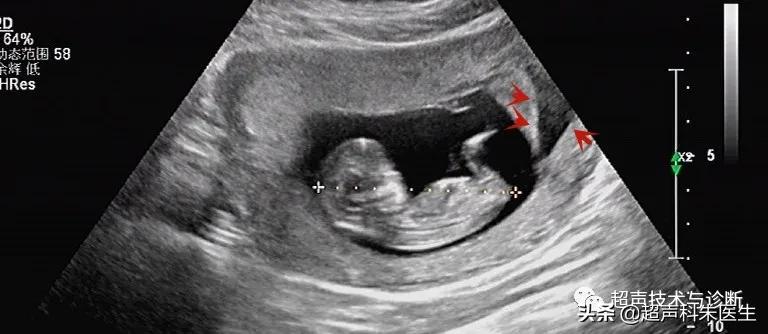 绒毛膜下血肿的超声鉴别诊断,绒毛膜下血肿的症状