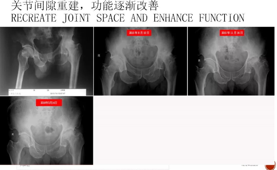对股骨头缺血性坏死疼痛的治疗体会