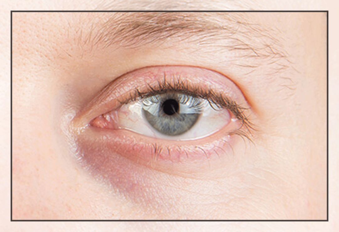 一次就能让黑眼圈消失的办法,一针下去瞬间没了黑眼圈