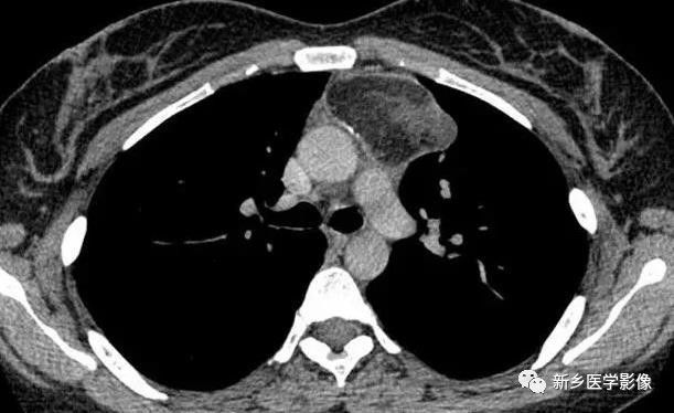 胸腺增生和纵隔肿瘤的区别和症状,纵隔胸腺肿瘤的常见临床症状表现
