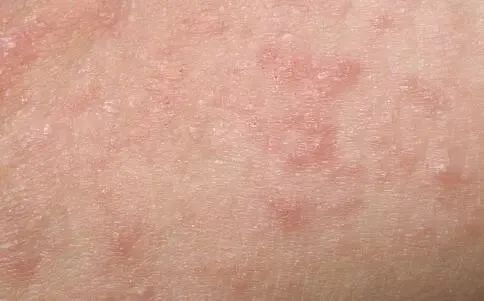 前胸后背长痘痘是毛囊炎吗,前胸后背很容易长痘痘中医治疗