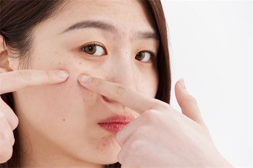 痘博士祛痘的烦恼,痘博士祛痘体验