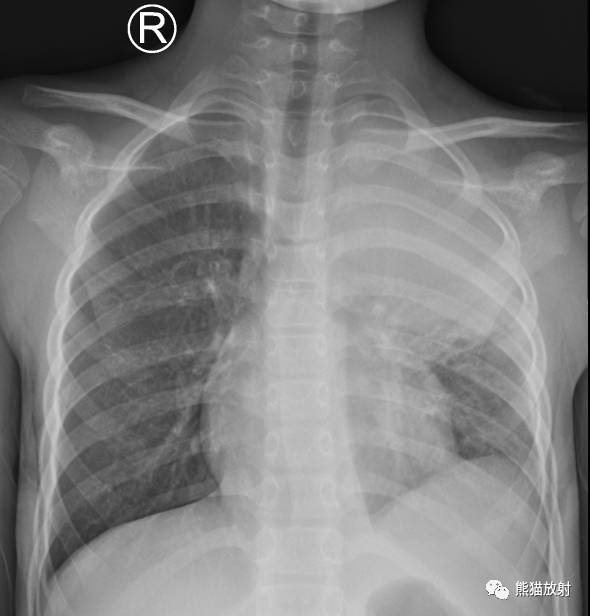 x线诊断边界模糊,x线诊断有误区吗