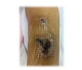 输液时肌腱损伤怎么办,输液造成组织坏死