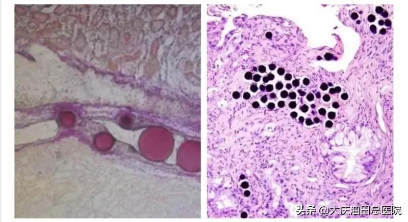微创介入手术从哪年开始的,介入微创手术成功率和后遗症