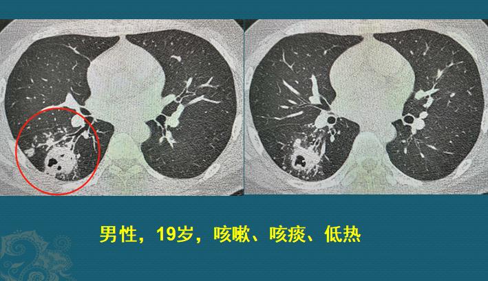肺结核预防性治疗需要休学吗,高中得肺结核休学半年会留级吗