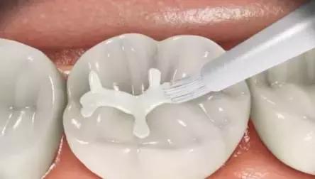 六岁换牙期需要注意什么,六岁换牙大牙换不换