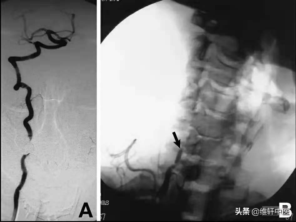 王氏中医导引踩跷法治疗“脑雾”现象