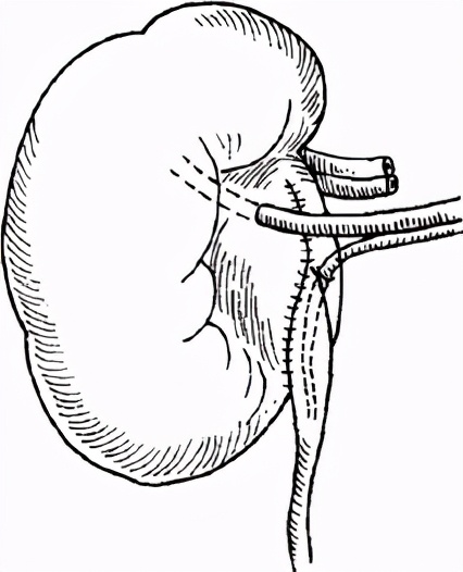 严重肾积水可以保守治疗吗,严重肾积水需要治疗吗