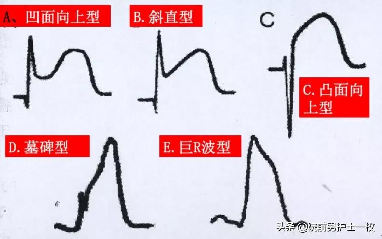 急性心梗的紧急处理视频,一旦发现急性心梗如何救