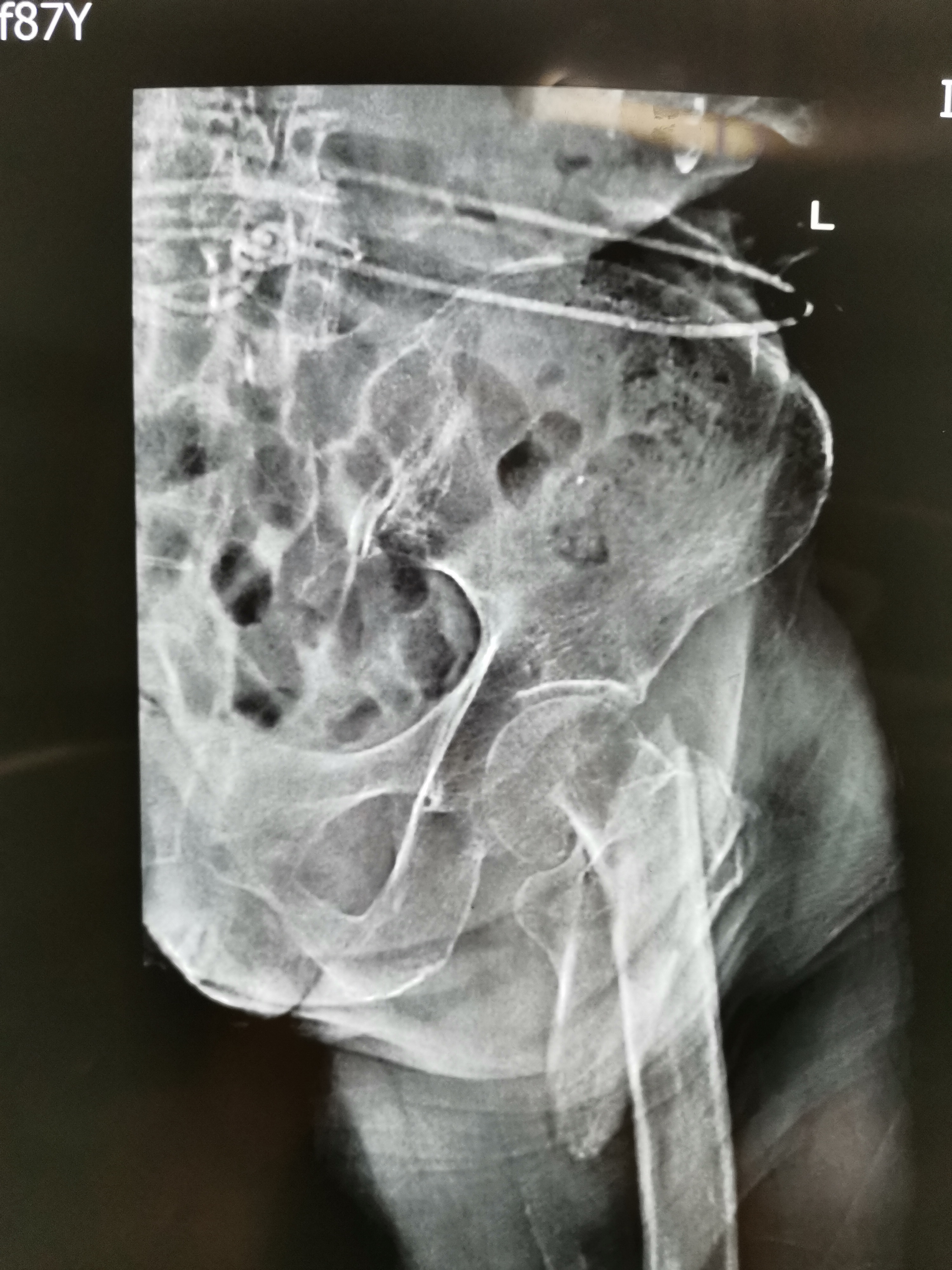 老人一屁股摔倒脊柱骨折如何治疗,老人一屁股坐地上怎么处理