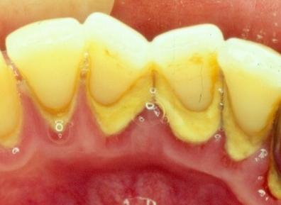 牙齿发黄有菌斑怎么办,牙齿泛黄很脏怎么办