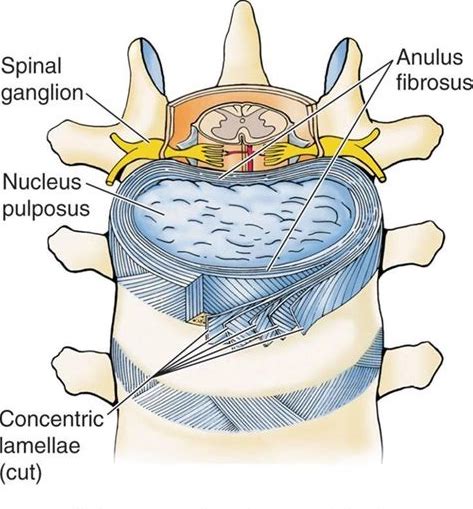 椎间盘突出痛苦,慢性腰椎间盘突出