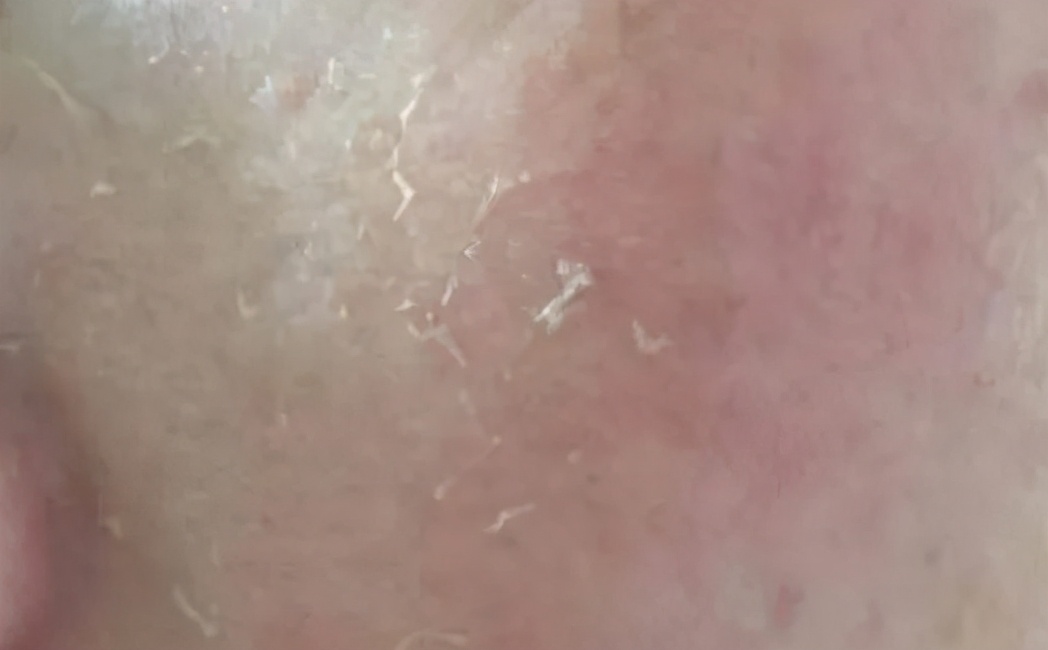 兰屋护肤小知识：刷酸这么神奇，要来试试吗？