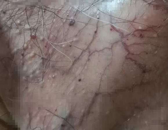 手上红点不痛不痒像血痣,手上不痛不痒的红点