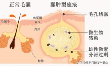 青春痘首选治疗方案是什么？答案都在这里了