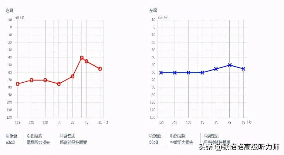 戴上人工耳蜗的大孩子,小孩第一次戴人工耳蜗反应