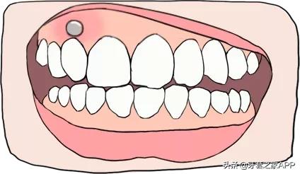 疫情时牙套遇到突发情况怎么办？应对办法在这里