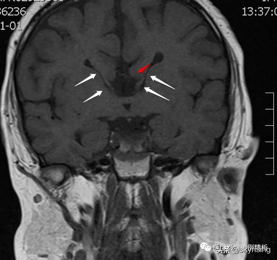 半叶全前脑畸形,无叶型前脑无裂畸形超声表现