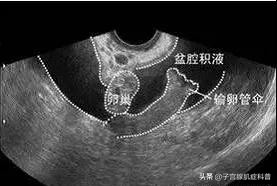 盆腔积液5.5*2.6怎样治疗,盆腔积液25mm严重吗要治疗多久