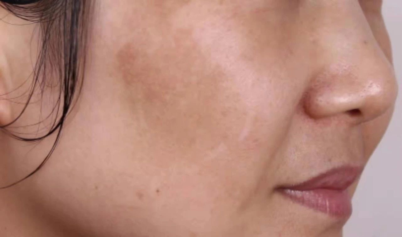 褐斑怎么治才能除根,根治面部黑褐斑的方法