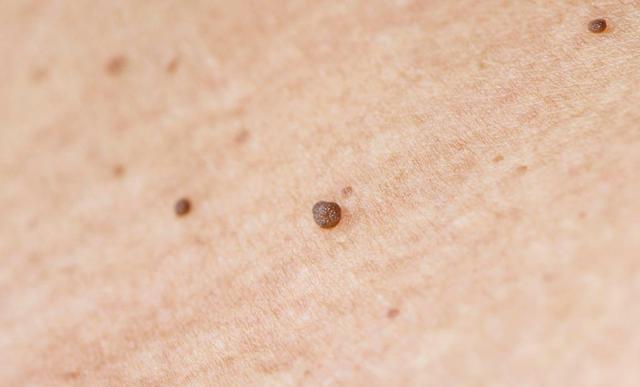 皮肤上冒出难看的“小肉球”，多半是这3种疾病的信号，别大意