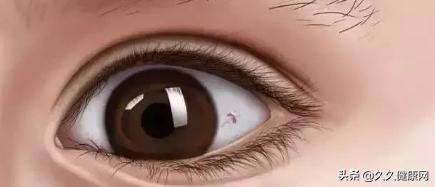 眼白上有黄斑会有什么后果,眼白有黑点是中邪了么