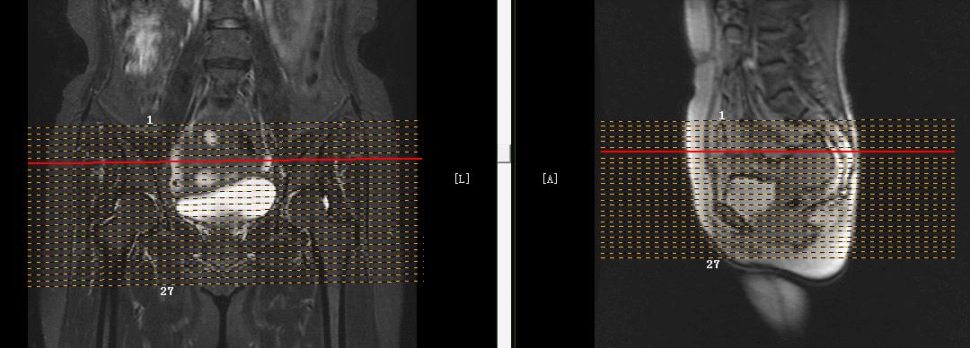 「精品课件」带大家看看,磁共振子宫MRI要如何扫描?