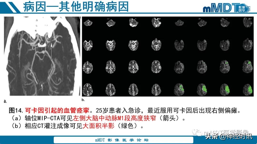 急性缺血性脑卒中ppt素材图片,青年缺血性脑卒中ppt