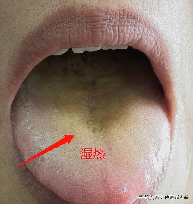 脸上长痘是肝胆湿热怎么办,湿热为什么会导致脸上出痘