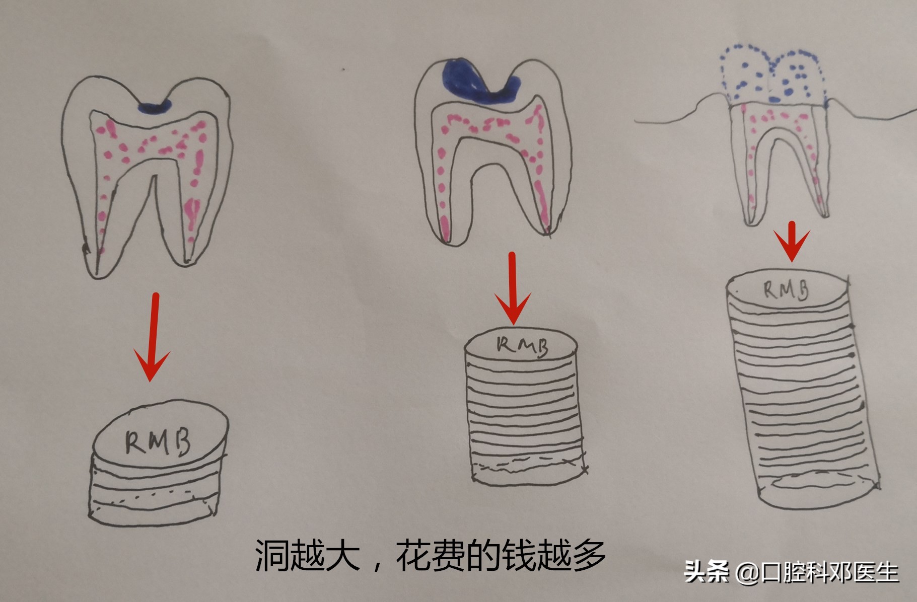 虫牙补牙方法有几种,虫洞露牙补牙的正确方法