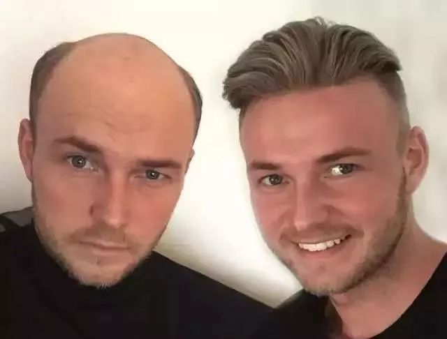 90后没有发际线,90后00后如何不脱发