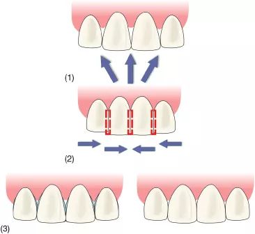 牙龈上有白色的牙垢刷不掉,牙龈里的黑东西