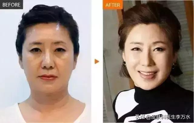 超声刀美容真的像张雨绮吗,张雨绮超声刀图片