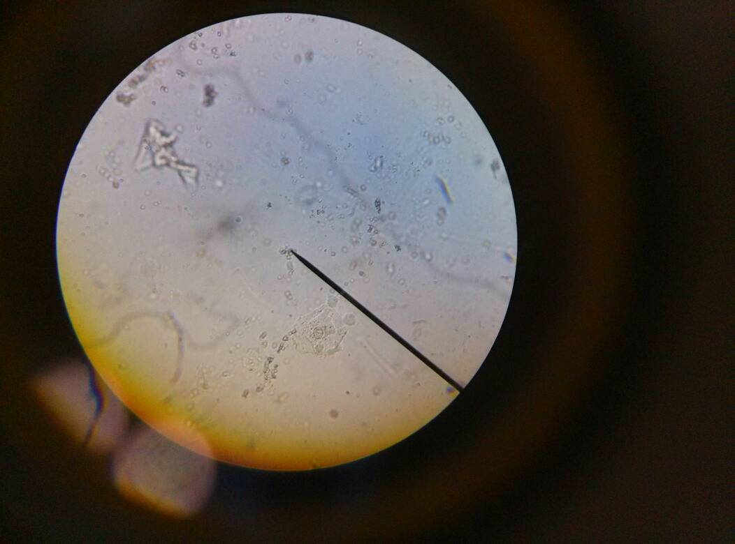 小儿李斯特菌病,常见于新生儿,以及有免疫缺陷的儿童,成人少见