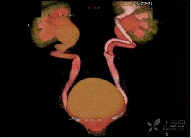 尿路梗阻导致肾积水不及时治疗,双肾积水是尿路梗阻吗