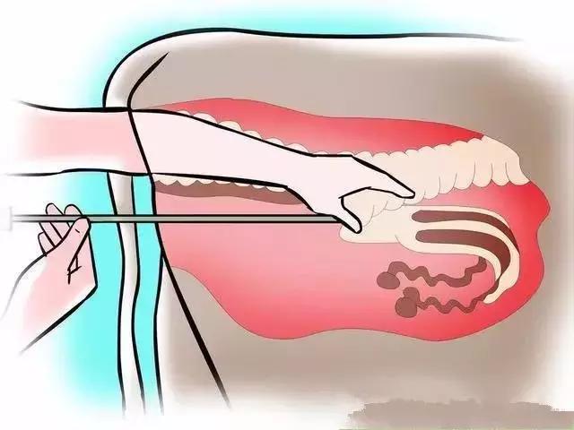 给母牛人工授精的步骤,给牛人工授精注意哪些