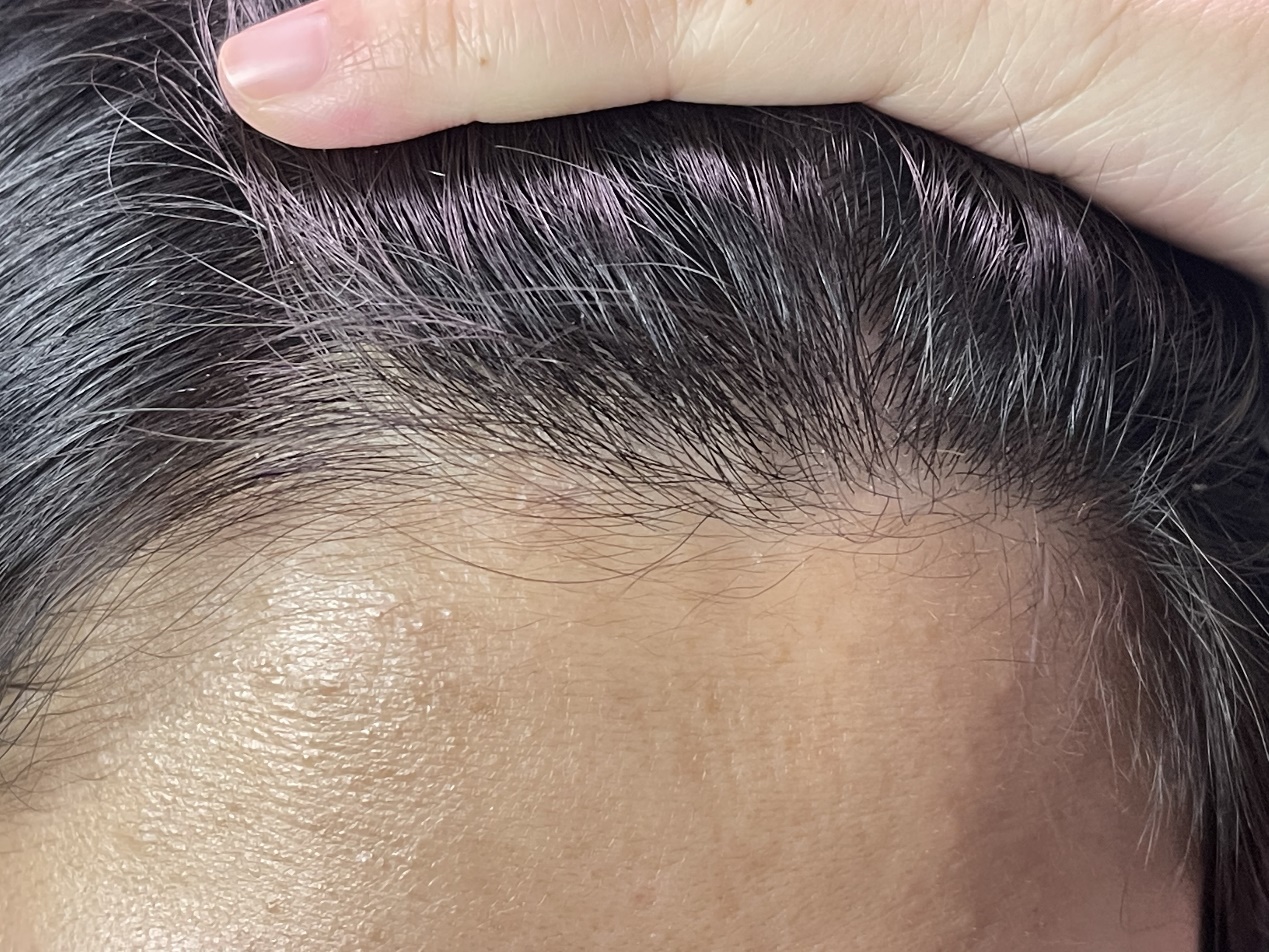 发际线保卫战视频,正式打响发际线保卫战