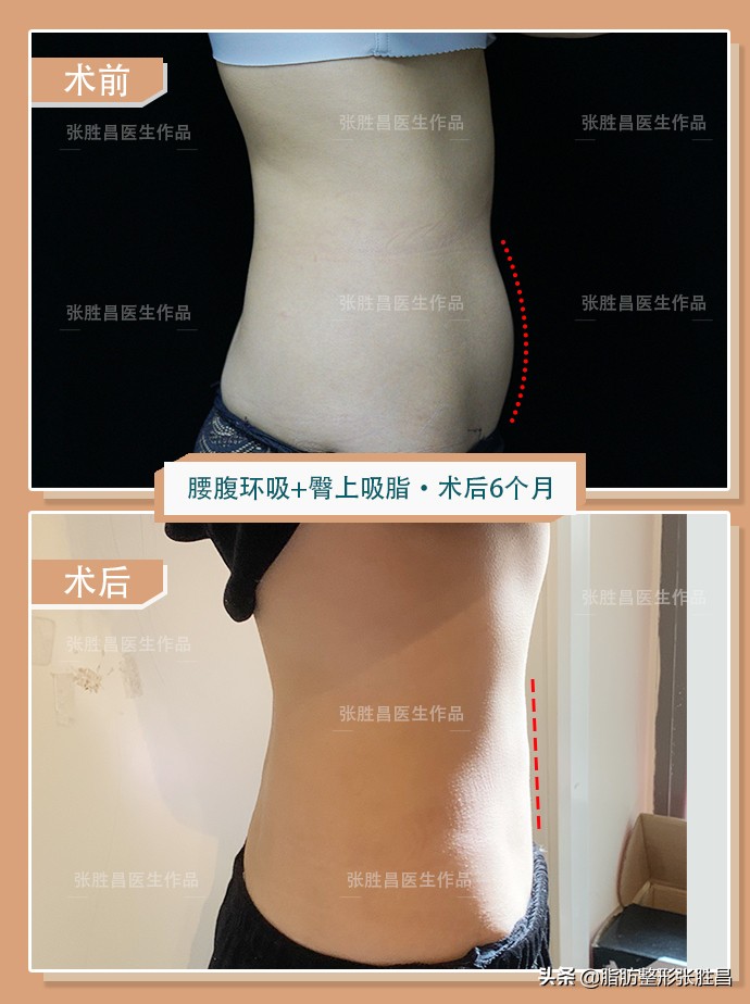 马甲线和腰腹吸脂有什么区别,想要马甲线不想运动