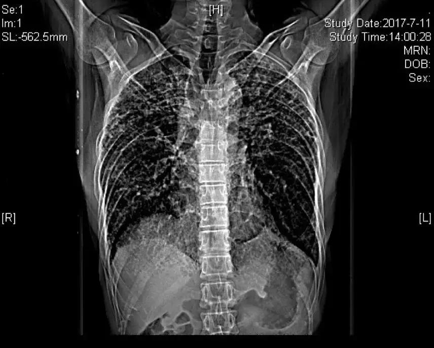 肺纤维化病例,肺纤维化手指甲发紫还能活多久