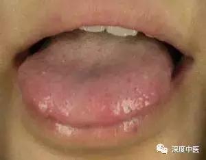 湿热体质的症状和调养,湿热体质的症状及调节