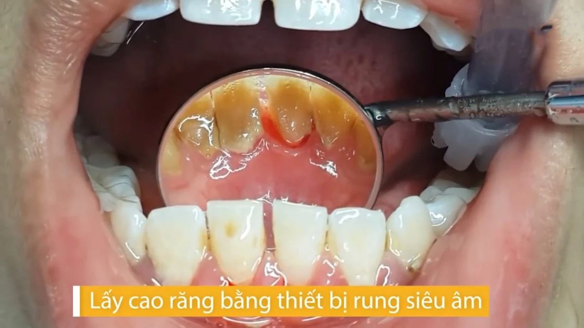 30秒带你了解洗牙,洗牙的过程短视频