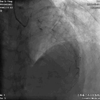 突发心肌梗死记住这5点,心肌梗死不能忽视的8个特别信号