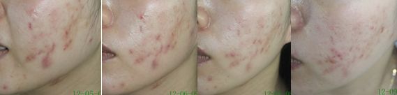 不同痘坑凹洞擦什么药膏,不同痘坑怎么修复