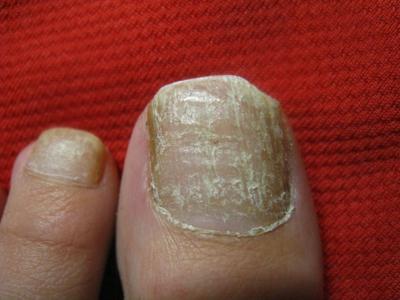 指甲增厚变色一定是灰指甲吗图片,指甲变空了发黄是灰指甲的图